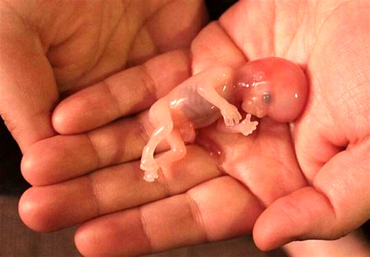 سقط جنین، ۳ برابر آمار تولد!